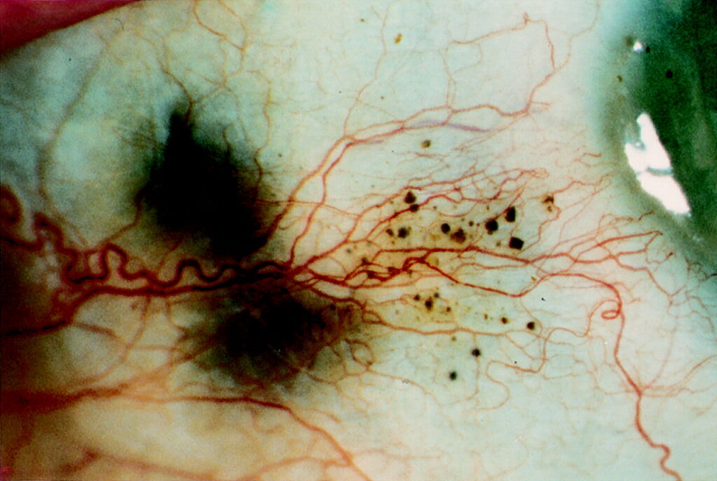 Alkaptonuria