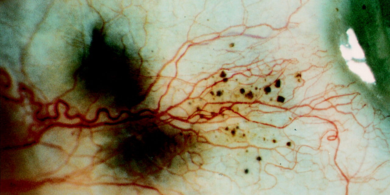 Alkaptonuria: Scleral Pigment That Signals a Metabolic Disease