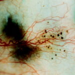 Alkaptonuria