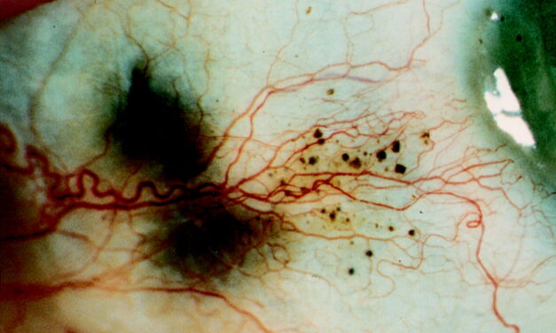 Alkaptonuria: Scleral Pigment That Signals a Metabolic Disease