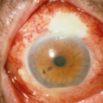 Clinical eye photograph illustrating Bleb Associated Endophthalmitis Risk Management