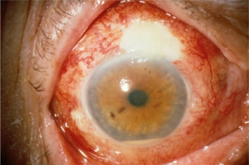 Bleb-Associated Endophthalmitis: A Lifelong Risk After Trabeculectomy