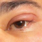 Dacryoadenitis