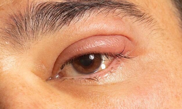 Dacryoadenitis: Superolateral Swelling With a Different Differential