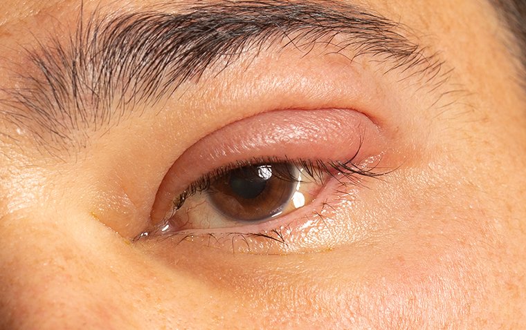 Dacryoadenitis
