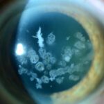 Granular Corneal Dystrophy