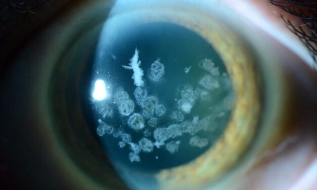 Granular Corneal Dystrophy: Discrete Deposits and a LASIK Warning