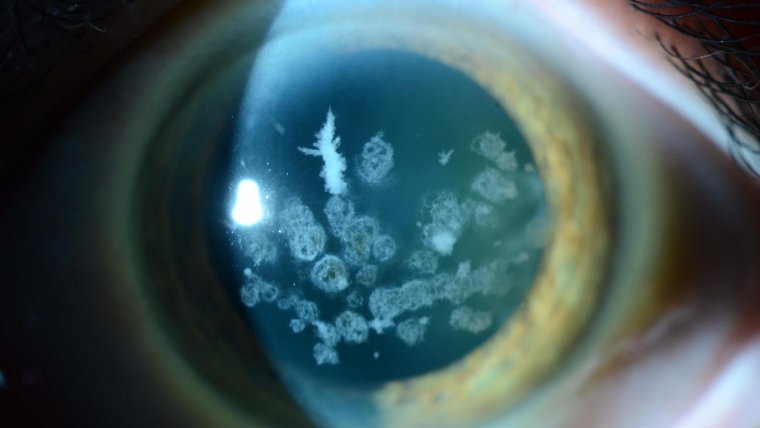 Granular Corneal Dystrophy: Discrete Deposits and a LASIK Warning