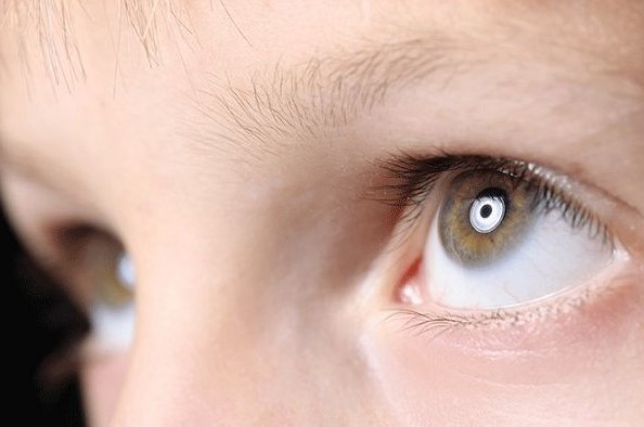 Balint Syndrome: Normal Eyes, Unable to See the Whole Scene