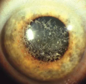 Granular Corneal Dystrophy