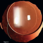 Clinical eye photograph illustrating Capsular Tension Ring Indications