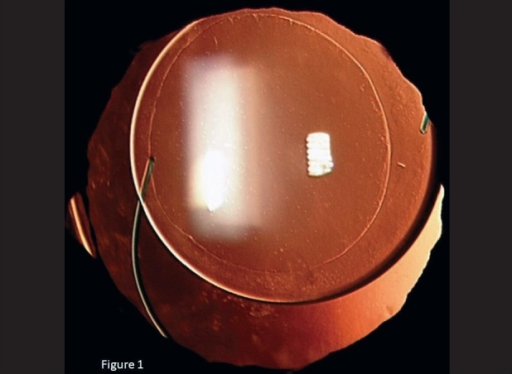 Capsular Tension Rings: A Simple Device That Rescues Difficult Cataract Cases