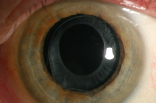 Clinical eye photograph illustrating Capsular Tension Ring Indications