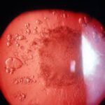 Clinical eye photograph illustrating Cataract Morphology Classification