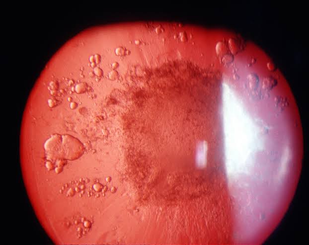 Cataract Morphology: Why Where the Lens Clouds Matters as Much as That It Does