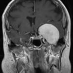 Clinical eye photograph illustrating Cavernous Sinus Syndrome Cranial Nerve Pattern
