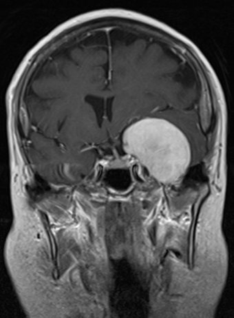 Cavernous Sinus Syndrome: Reading the Cranial Nerve Pattern to Find the Lesion