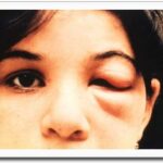 Romana's sign: unilateral painless periorbital and eyelid edema at the site of Trypanosoma cruzi inoculation
