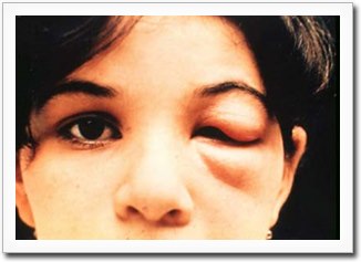 Chagas Disease: Romana’s Sign as the Ocular Entry Point