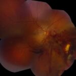 Clinical eye photograph illustrating Chorioretinitis Sclopetaria Trauma