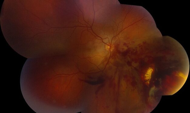Chorioretinitis Sclopetaria: The Retinal Scar That Forms Without the Globe Ever Being Struck