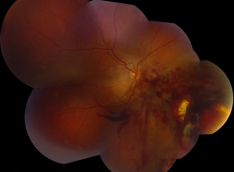 Clinical eye photograph illustrating Chorioretinitis Sclopetaria Trauma