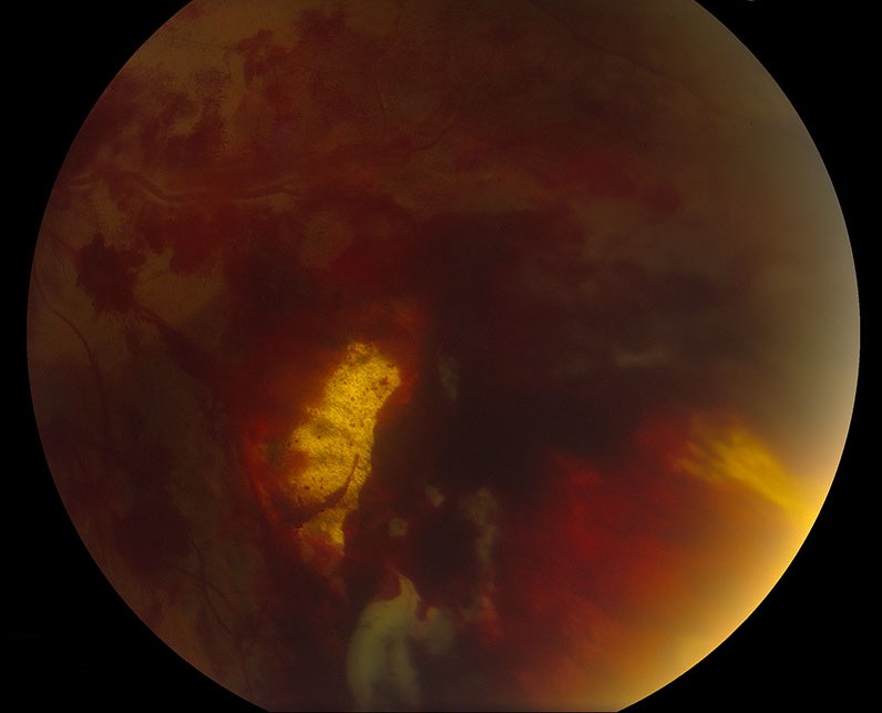 Clinical eye photograph illustrating Chorioretinitis Sclopetaria Trauma