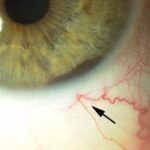 Clinical eye photograph illustrating Ciliary Body Melanoma Diagnosis