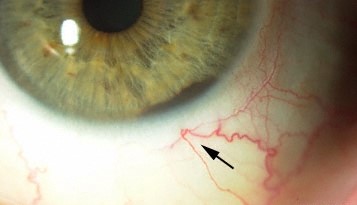 Ciliary Body Melanoma: A Hidden Tumor That Presents Late