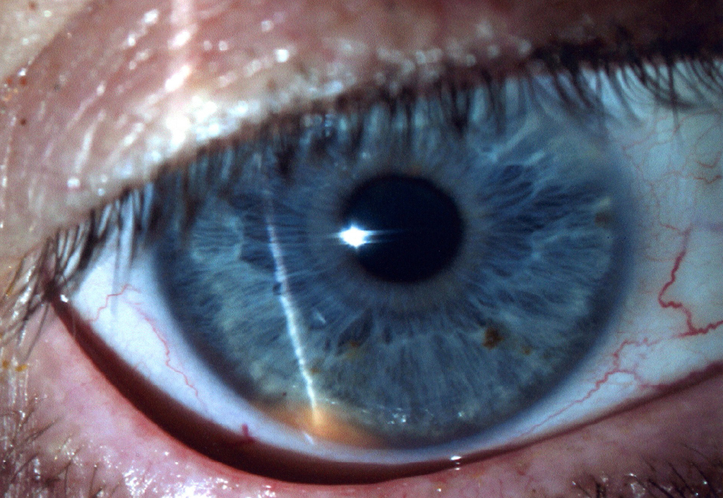Clinical eye photograph illustrating Ciliary Body Melanoma Diagnosis