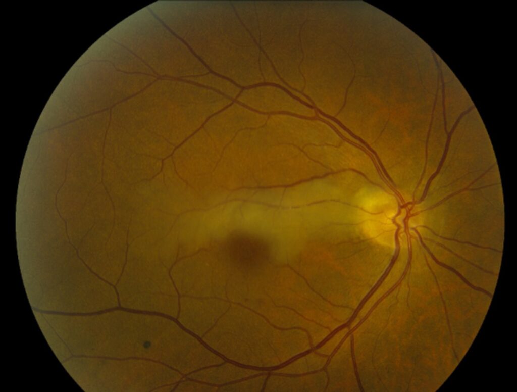 Cilioretinal Artery Occlusion