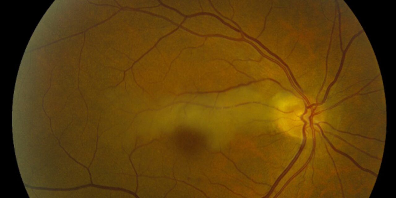 Cilioretinal Artery Occlusion: The Vessel That Isn’t Always There