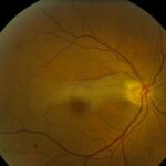 Cilioretinal Artery Occlusion