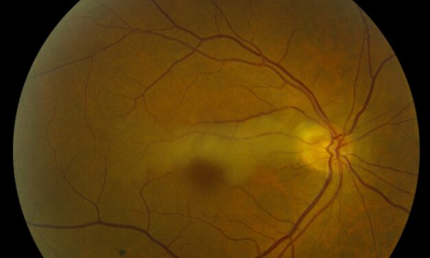 Cilioretinal Artery Occlusion: The Vessel That Isn’t Always There
