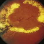 Clinical eye photograph illustrating Coats Like Retinal Telangiectasia