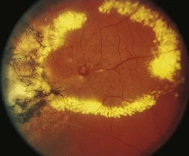 Coats-Like Retinal Telangiectasia: When Leaky Vessels Mimic a Tumor
