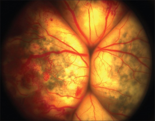 Clinical eye photograph illustrating Coats Like Retinal Telangiectasia