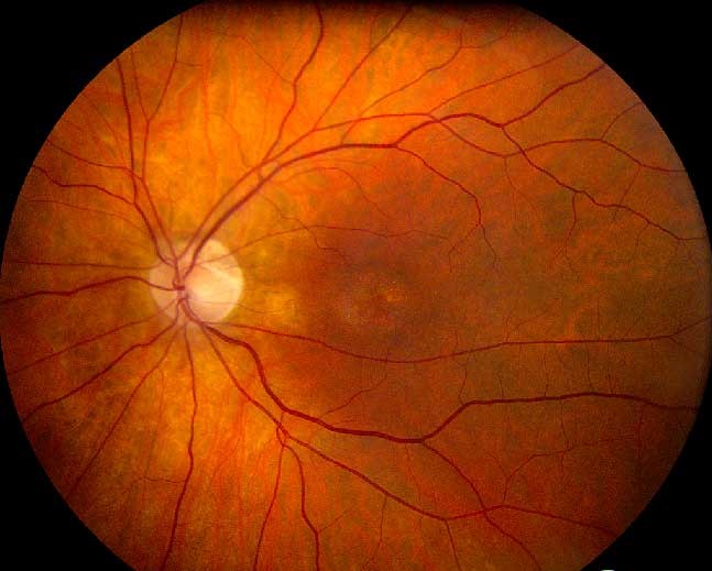 Cone-Rod Dystrophy