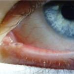 Clinical eye photograph illustrating Congenital Nasolacrimal Duct Obstruction Management