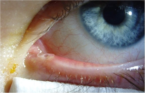 Congenital Nasolacrimal Duct Obstruction: When to Wait, Massage, or Probe