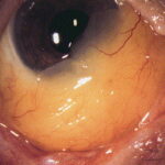 Clinical eye photograph illustrating Conjunctival Amyloidosis Eye