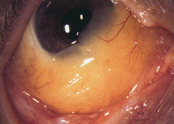 Conjunctival Amyloidosis: When Protein Deposits Mimic a Vascular Mass