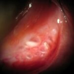 Clinical eye photograph illustrating Conjunctival Concretions Management