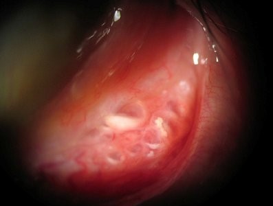 Conjunctival Concretions: The Chalky Deposits Hiding Under the Eyelid