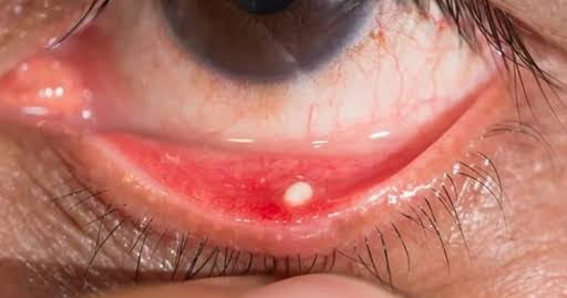Clinical eye photograph illustrating Conjunctival Concretions Management