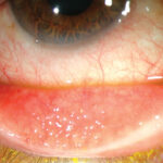 Clinical eye photograph illustrating Conjunctival Follicles vs Papillae Differential