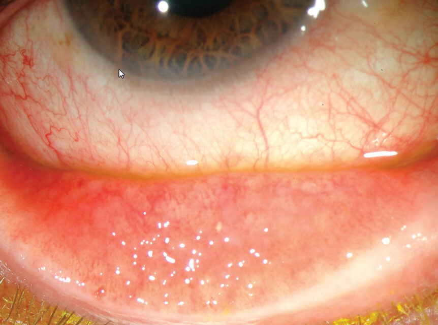 Conjunctival Follicles Versus Papillae: A Distinction That Narrows Your Whole Differential