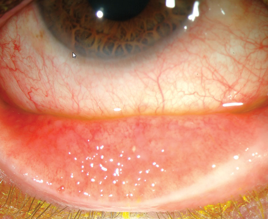 Clinical eye photograph illustrating Conjunctival Follicles vs Papillae Differential