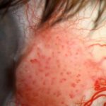 Clinical eye photograph illustrating Conjunctival Intraepithelial Neoplasia Diagnosis
