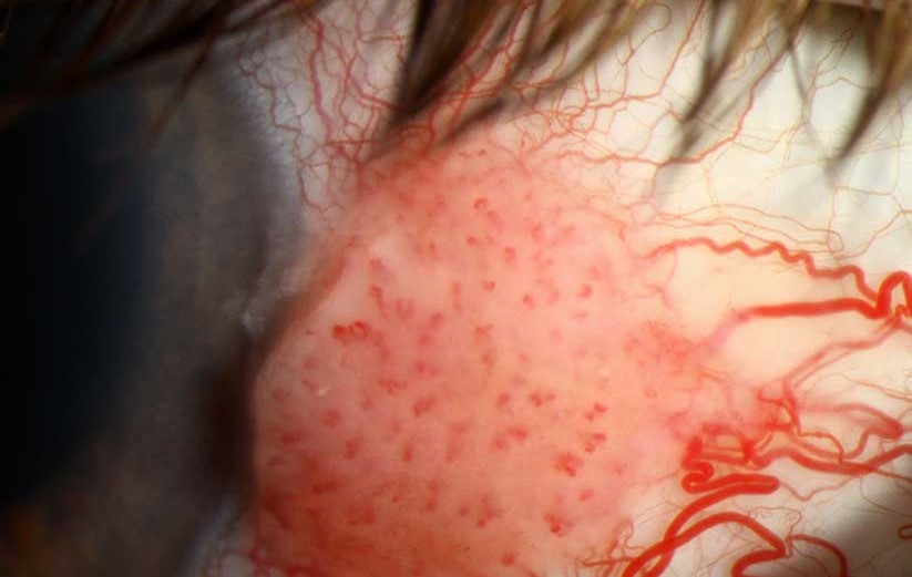 Conjunctival Intraepithelial Neoplasia: The Gelatinous Limbal Lesion That Needs Tissue, Not Just a Look